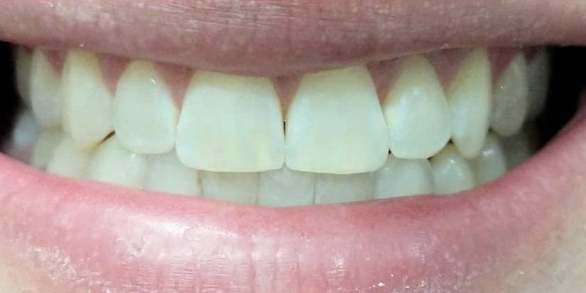 Straighten patients teeth with Invisalign in Leesburg, VA