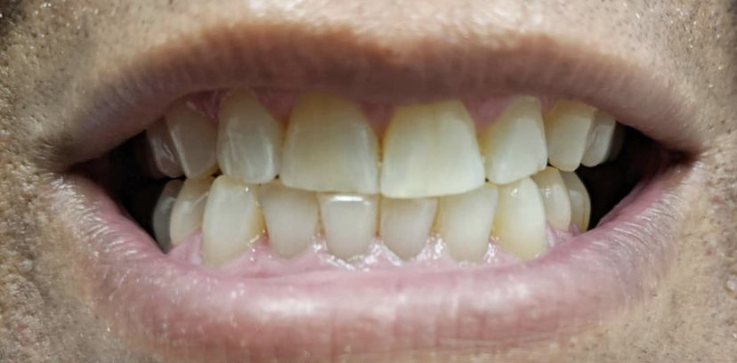 Before Teeth Whitening Treatment