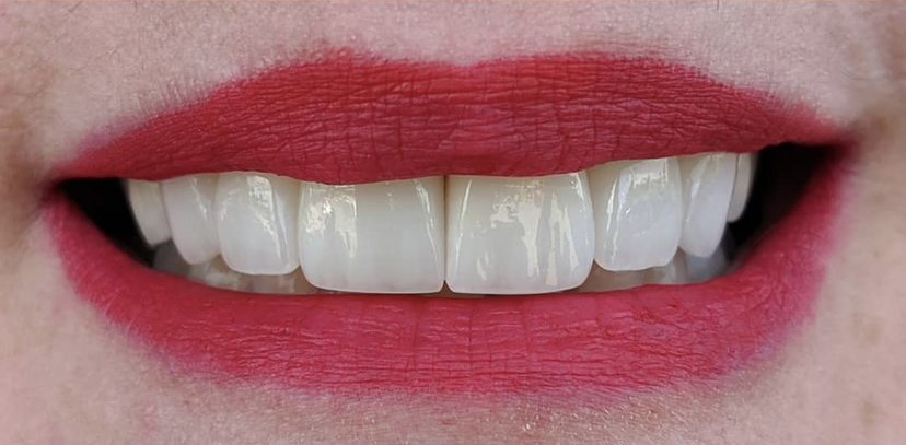 After Dental Veneers in Leesburg, VA