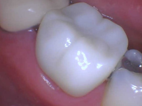 Saved Tooth by giving it a Dental Crown in Leesburg, VA