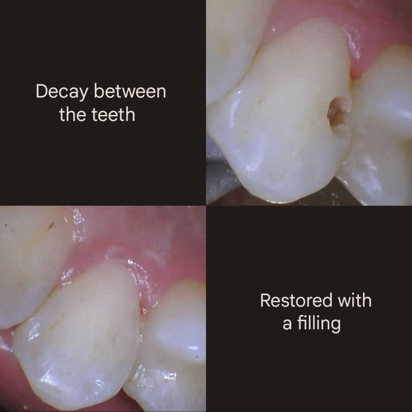 dental-fllings 1