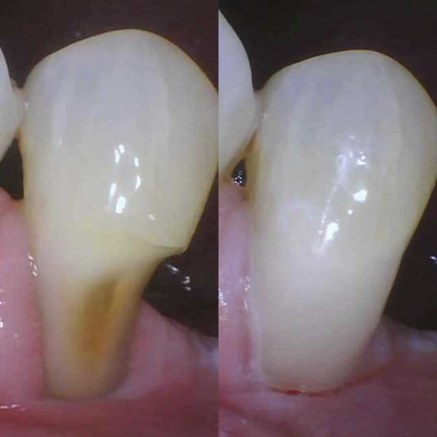 dental-fllings 2
