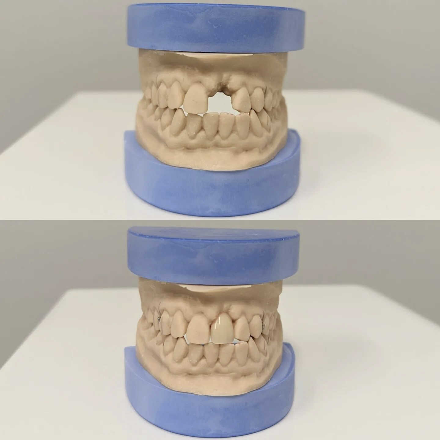 dental-fllings 1